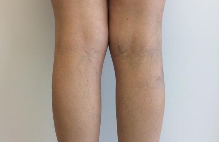 Antes e depois do CLaCS