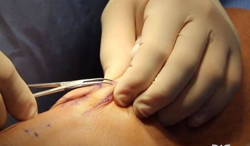 Flebectomia para varizes