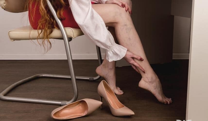 Mulher com vasinhos nas pernas