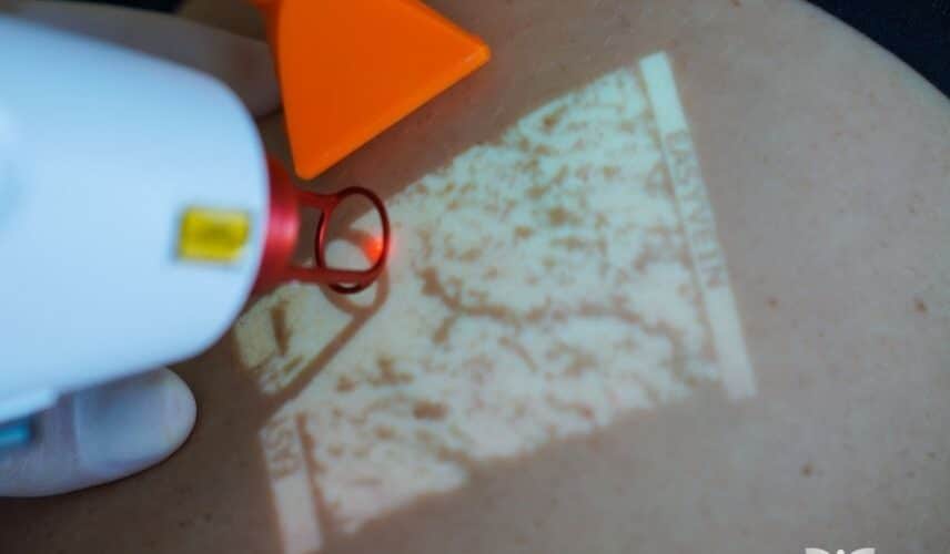 Laser transdérmico sendo aplicado em tratamento de varizes