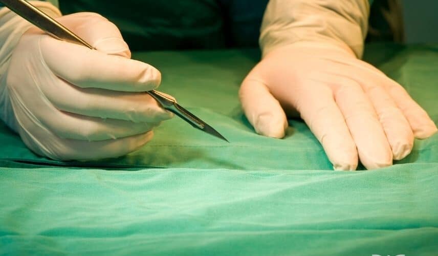 Incisão de uma safenectomia