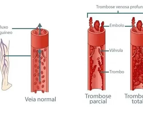 Como a trombose venosa profunda afeta as veias