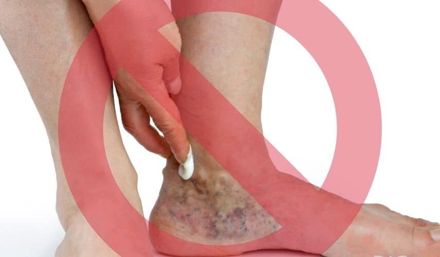 Os 4 principais motivos para não tratar varizes