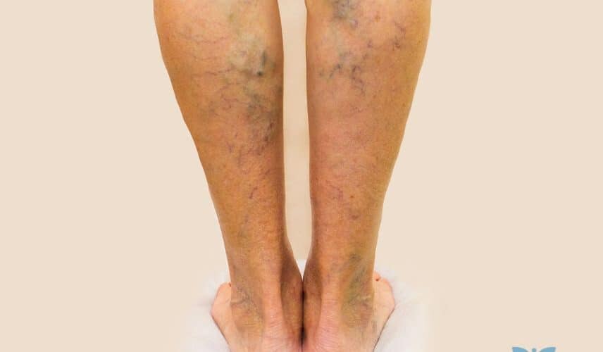 Perna com sintoma de varizes visíveis a olho nu