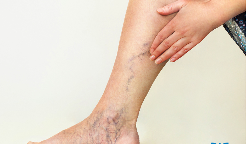 Exemplo de má circulação nas pernas