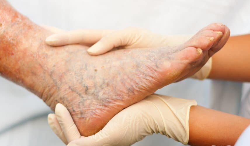 Varizes no pé de homem