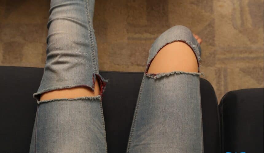 Exemplo de pernas com varizes na adolescência