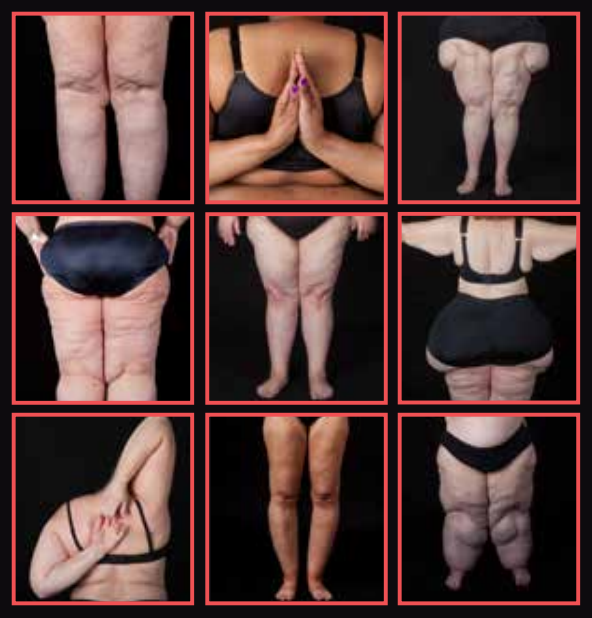 Lipedema: acúmulo desproporcional de gordura nas pernas tem explicação e  tratamento - Minha Vida