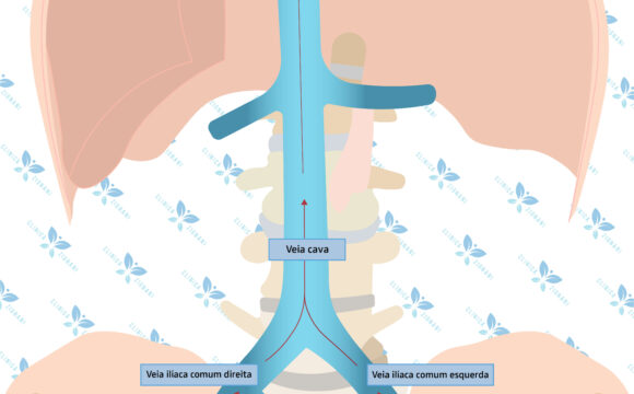 Esquema representando as veias ilíacas