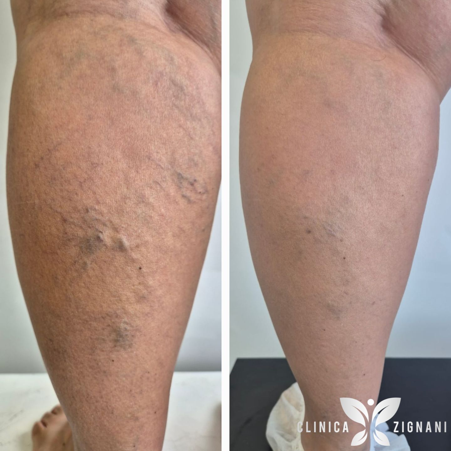 Antes e depois de tratamento de varizes com endolaser