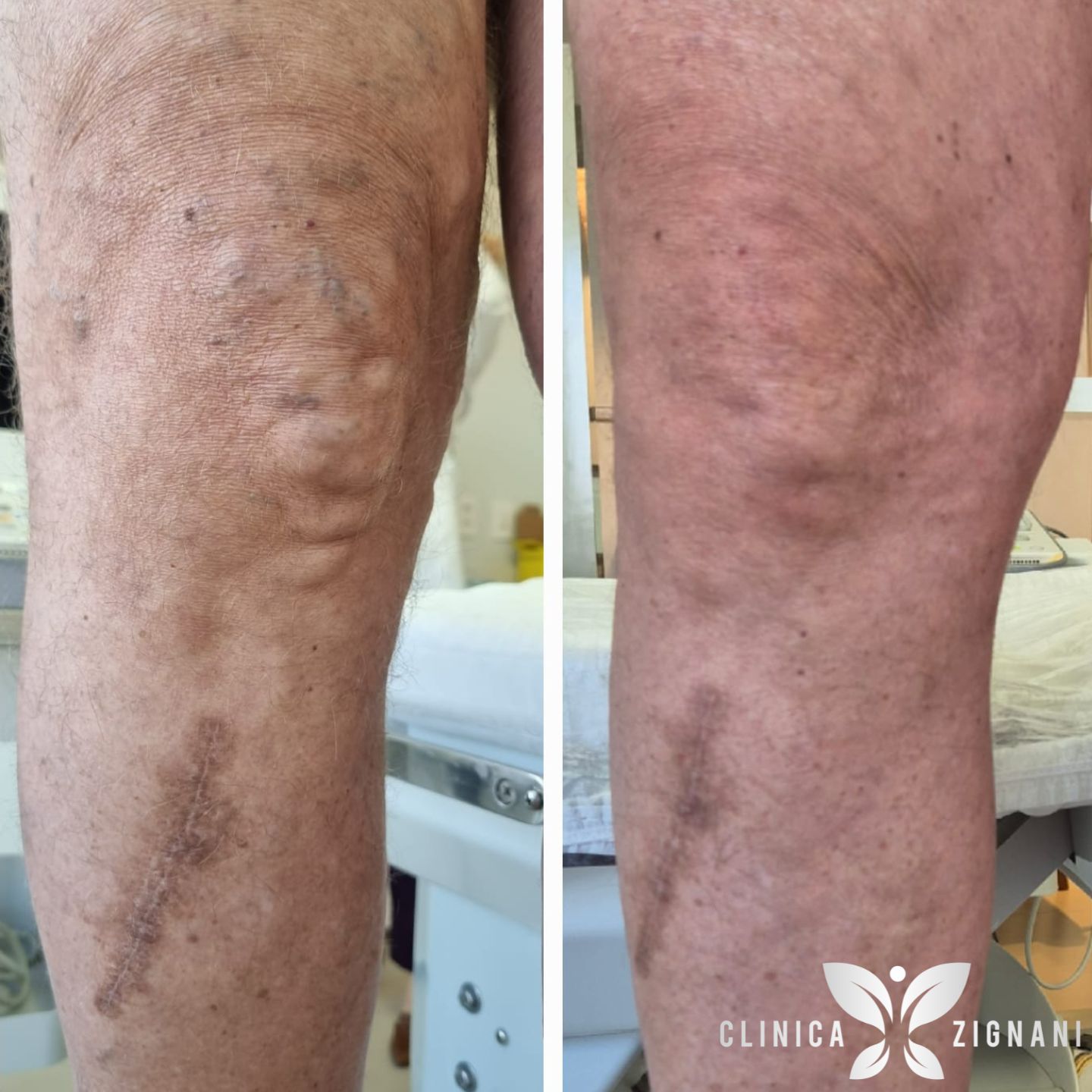 Antes e depois de tratamento de varizes com endolaser