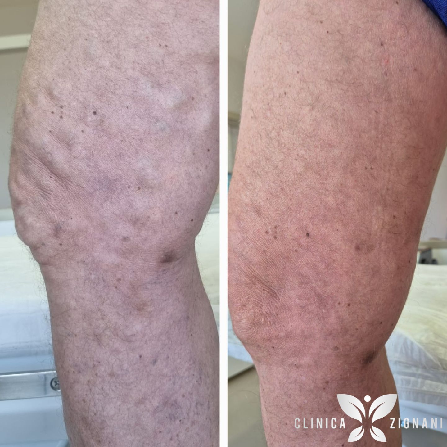 Antes e depois de tratamento de varizes com endolaser