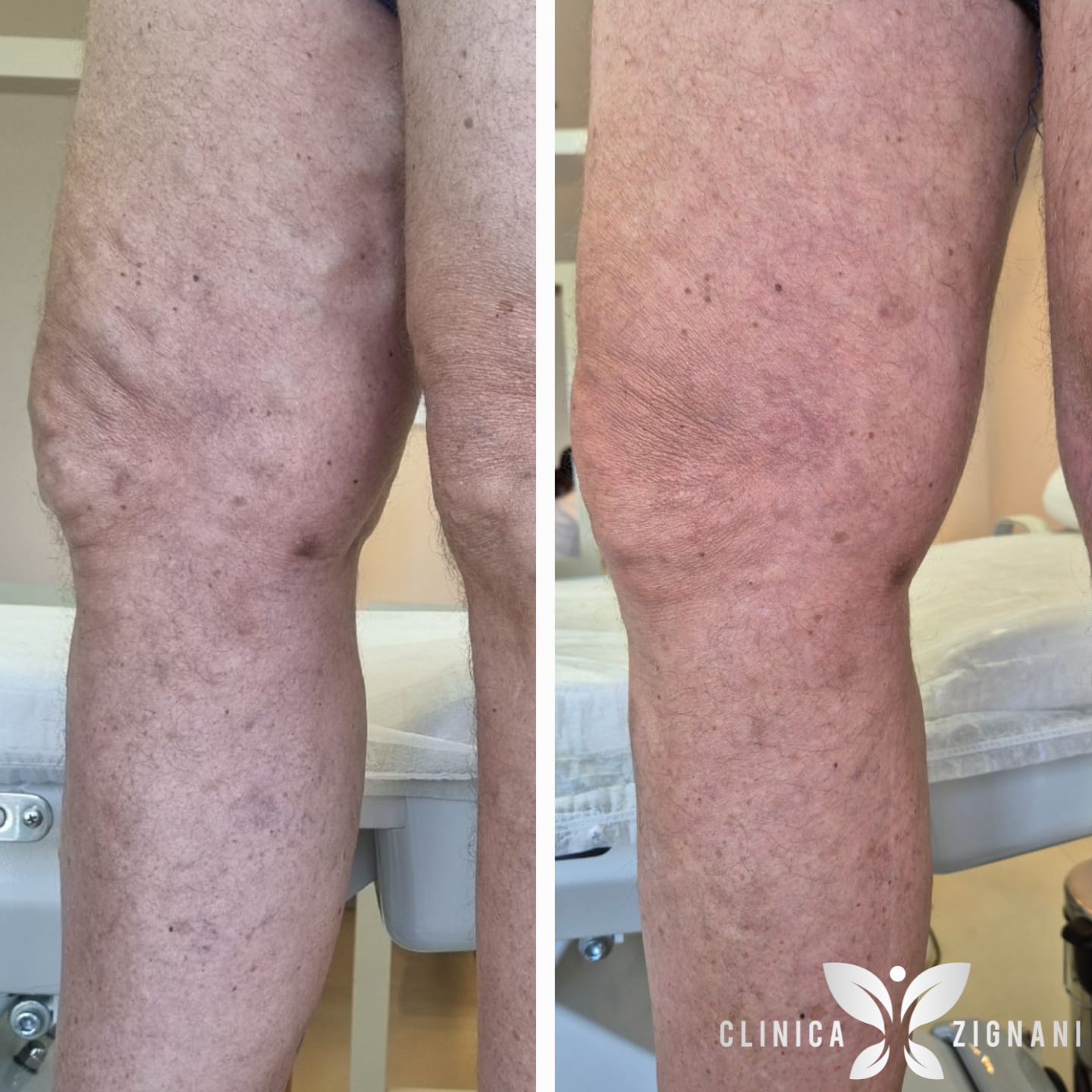 Antes e depois de tratamento de varizes com endolaser