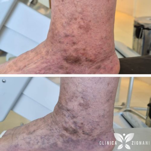 Antes e depois de tratamento de varizes com endolaser