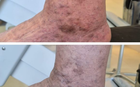 Antes e depois de tratamento de varizes com endolaser