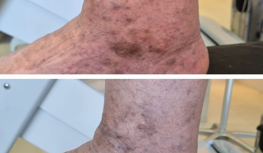 Antes e depois de tratamento de varizes com endolaser