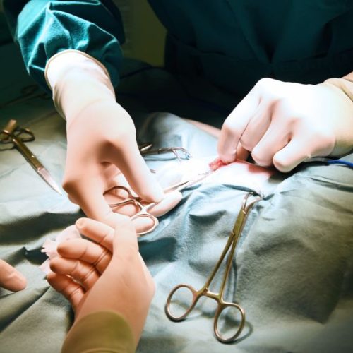 Procedimento de cirurgia de varizes em curso